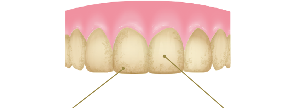 黄ばんだ歯のイラスト